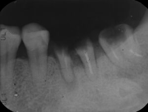 根の虫歯で抜歯になった下顎の奥歯をインプラントで再建した症例2